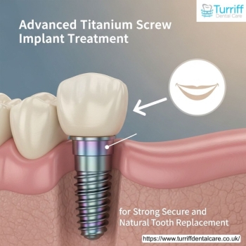 Advanced Titanium Screw Implant Treatment for Strong Secure and Natural Tooth Replacement